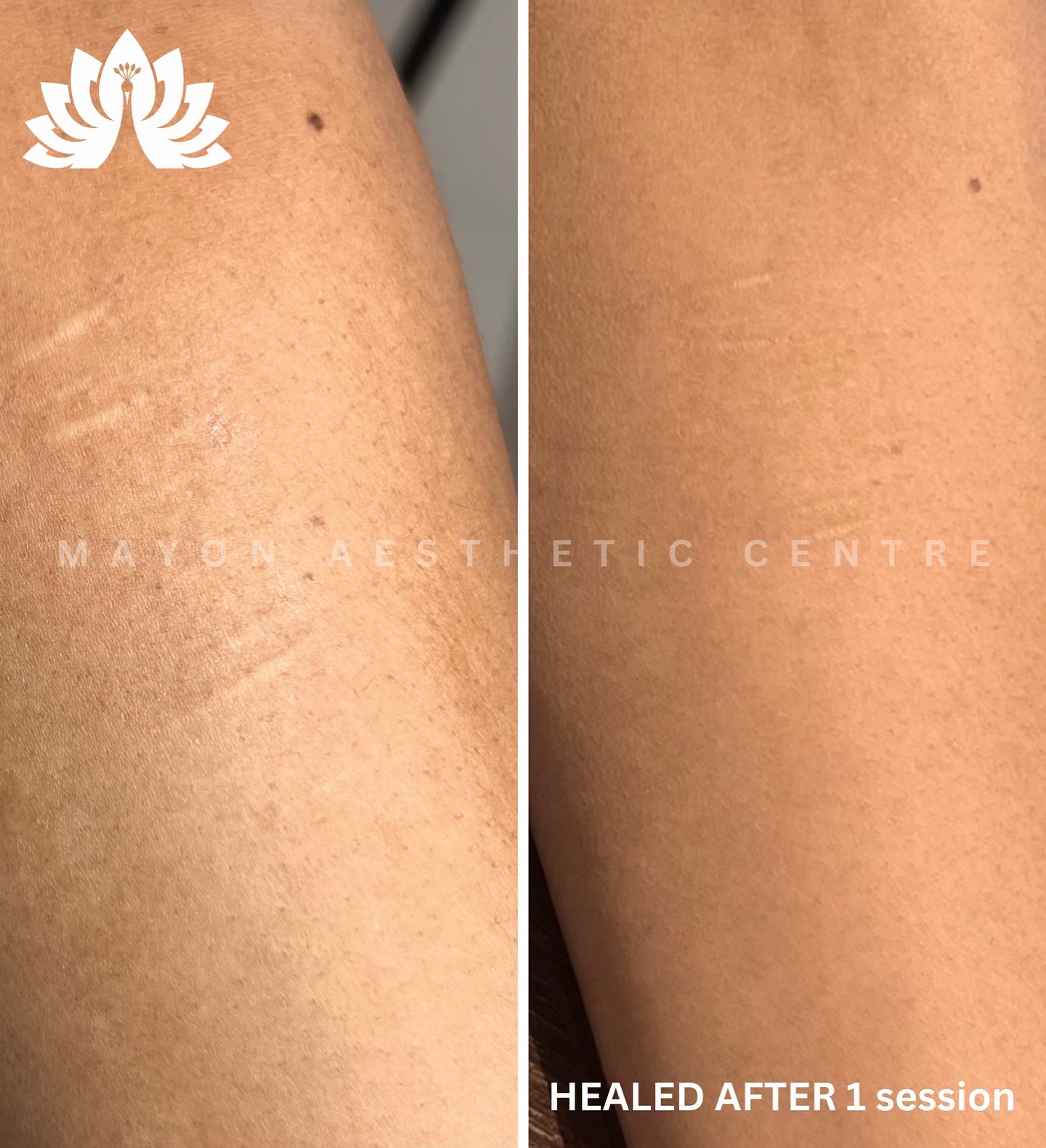 Scar Camouflage